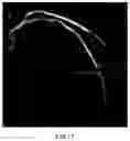 Fig. 11 - METHOD, APPARATUS AND SYSTEM FOR CONVENIENTLY MEASURING CORONARY ARTERY VASCULAR EVALUATION PARAMETERS