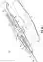 Fig. 06 - Vessel closure devices and methods