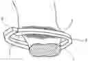 Fig. 01 - ORGAN RESECTION STUMP FIXING CLIP