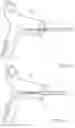 Fig. 07 - Transcatheter device and minimally invasive method for constricting and adjusting blood flow through a blood vessel