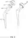 Fig. 04 - Methods and systems for bone mounted robotic-assisted hip and shoulder surgical systems