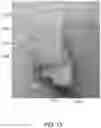 Fig. 10 - Methods and systems for bone mounted robotic-assisted hip and shoulder surgical systems