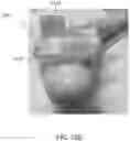 Fig. 16 - Methods and systems for bone mounted robotic-assisted hip and shoulder surgical systems