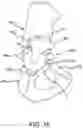 Fig. 21 - Methods and systems for bone mounted robotic-assisted hip and shoulder surgical systems