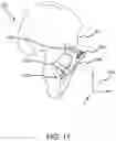 Fig. 22 - Methods and systems for bone mounted robotic-assisted hip and shoulder surgical systems