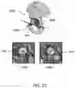 Fig. 27 - Methods and systems for bone mounted robotic-assisted hip and shoulder surgical systems