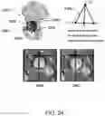 Fig. 28 - Methods and systems for bone mounted robotic-assisted hip and shoulder surgical systems