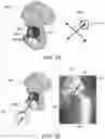 Fig. 29 - Methods and systems for bone mounted robotic-assisted hip and shoulder surgical systems