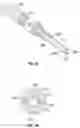 Fig. 10 - Lesion crossing shock wave catheter