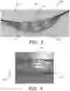 Fig. 03 - Systems and methods for intravascular obstruction removal