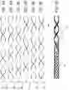 Fig. 07 - Systems and methods for intravascular obstruction removal