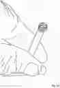 Fig. 16 - Extramedullary internal bone lengthening and fixation device with dynamic axial stabilization