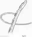 Fig. 20 - Extramedullary internal bone lengthening and fixation device with dynamic axial stabilization