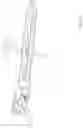 Fig. 23 - Extramedullary internal bone lengthening and fixation device with dynamic axial stabilization