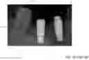 Fig. 03 - APPARATUS AND METHOD OF AN OSTEOTOMY FOR DENTAL IMPLANT