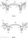 Fig. 05 - APPARATUS AND METHOD OF AN OSTEOTOMY FOR DENTAL IMPLANT