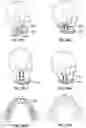 Fig. 20 - APPARATUS AND METHOD OF AN OSTEOTOMY FOR DENTAL IMPLANT