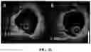 Fig. 25 - SYSTEMS AND METHODS FOR LASER-INDUCED CALCIUM FRACTURES