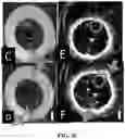 Fig. 26 - SYSTEMS AND METHODS FOR LASER-INDUCED CALCIUM FRACTURES