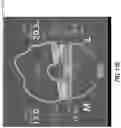 Fig. 24 - Soft tissue balancing in articular surgery