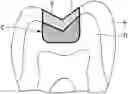 Fig. 01 - DENTAL RESTORATIVE SET AND METHOD OF RESTORING TOOTH