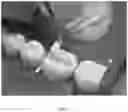 Fig. 08 - 3D DATA GENERATION FOR PROSTHETIC CROWN PREPARATION OF TOOTH