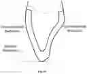 Fig. 11 - 3D DATA GENERATION FOR PROSTHETIC CROWN PREPARATION OF TOOTH