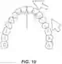 Fig. 10 - DENTAL ALIGNERS AND PROCEDURES FOR ALIGNING TEETH