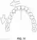 Fig. 11 - DENTAL ALIGNERS AND PROCEDURES FOR ALIGNING TEETH
