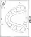 Fig. 28 - DENTAL ALIGNERS AND PROCEDURES FOR ALIGNING TEETH
