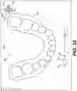 Fig. 32 - DENTAL ALIGNERS AND PROCEDURES FOR ALIGNING TEETH
