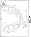 Fig. 37 - DENTAL ALIGNERS AND PROCEDURES FOR ALIGNING TEETH