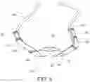 Fig. 06 - Intra-oral appliance