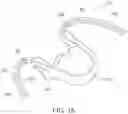 Fig. 16 - Intra-oral appliance