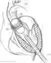 Fig. 01 - Transapical heart valve delivery system