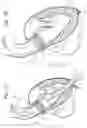 Fig. 06 - Transapical heart valve delivery system