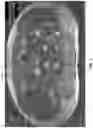 Fig. 02 - EXPANDABLE INTERBODY FUSION DEVICE FOR USE WITH POSTERIOR TO LATERAL APPROACH