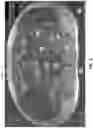 Fig. 03 - EXPANDABLE INTERBODY FUSION DEVICE FOR USE WITH POSTERIOR TO LATERAL APPROACH