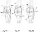 Fig. 40 - Apparatus and method for evaluating knee geometry