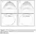 Fig. 07 - METHOD AND APPARATUS TO MODIFY THE CORNEA USING ELECTROCHEMISTRY