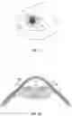 Fig. 02 - DEVICES AND METHODS FOR TREATING AQUEOUS COLLECTOR CHANNELS OF AN EYE TO REDUCE INTRAOCULAR PRESSURE