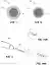 Fig. 07 - Personalization of excimer laser fibers