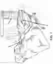 Fig. 09 - INFANT WARMER MATTRESS SUPPORT EXTENSION APPARATUS AND METHOD OF USE