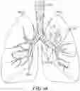 Fig. 45 - IMPLANTABLE DEPOTS FOR THE LOCALIZED, SUSTAINED, CONTROLLED RELEASE OF THERAPEUTIC AGENTS TO TREAT CANCER AND RELATED SYMPTOMS AND CONDITIONS