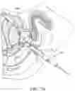 Fig. 55 - IMPLANTABLE DEPOTS FOR THE LOCALIZED, SUSTAINED, CONTROLLED RELEASE OF THERAPEUTIC AGENTS TO TREAT CANCER AND RELATED SYMPTOMS AND CONDITIONS