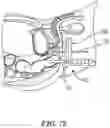 Fig. 57 - IMPLANTABLE DEPOTS FOR THE LOCALIZED, SUSTAINED, CONTROLLED RELEASE OF THERAPEUTIC AGENTS TO TREAT CANCER AND RELATED SYMPTOMS AND CONDITIONS