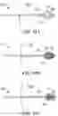 Fig. 79 - IMPLANTABLE DEPOTS FOR THE LOCALIZED, SUSTAINED, CONTROLLED RELEASE OF THERAPEUTIC AGENTS TO TREAT CANCER AND RELATED SYMPTOMS AND CONDITIONS