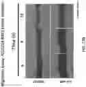 Fig. 31 - COMPOSITIONS AND METHODS FOR THE TREATMENT OF ABERRANT ANGIOGENESIS