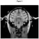 Fig. 02 - AAV VECTOR TREATMENT METHODS FOR LATE INFANTILE NEURONAL CEROID LIPOFUSCINOSIS TYPE 2