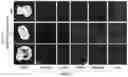 Fig. 14 - Multi-subunit vaccines to elicit both MHC- and CD1-restricted T cell responses